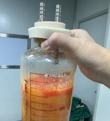 单县水动力吸脂手术要做多久？